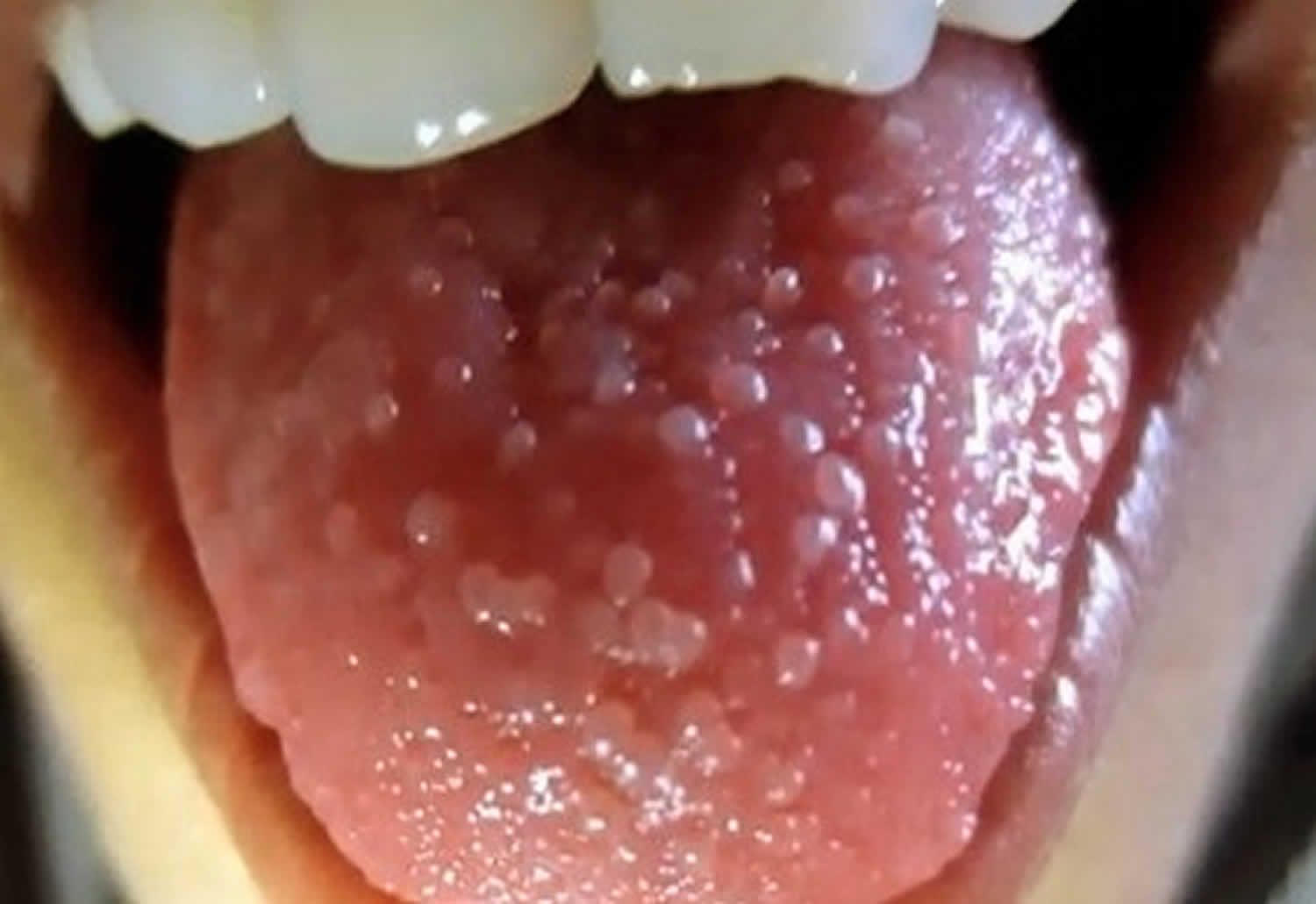 What Are Lie Spots On Tongue