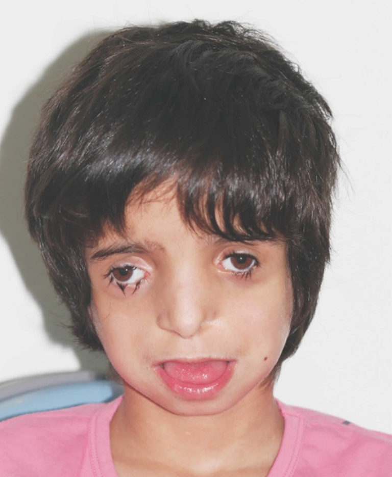 Treacher Collins syndrome causes, signs, symptoms, diagnosis & treatment