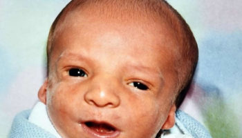 Treacher Collins syndrome