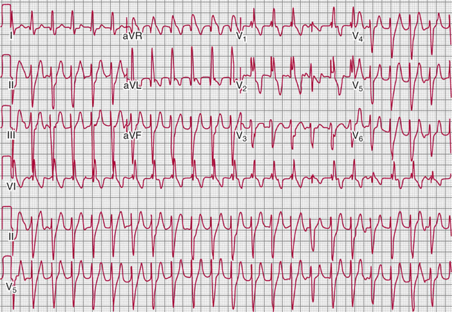 what is a tachycardia