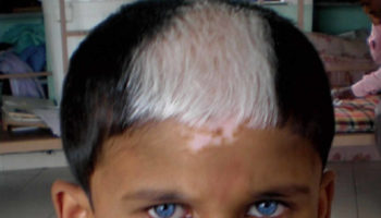 Waardenburg syndrome