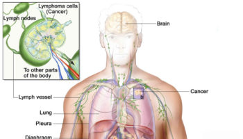 Waldenstrom macroglobulinemia