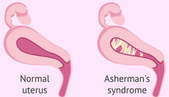 Asherman syndrome