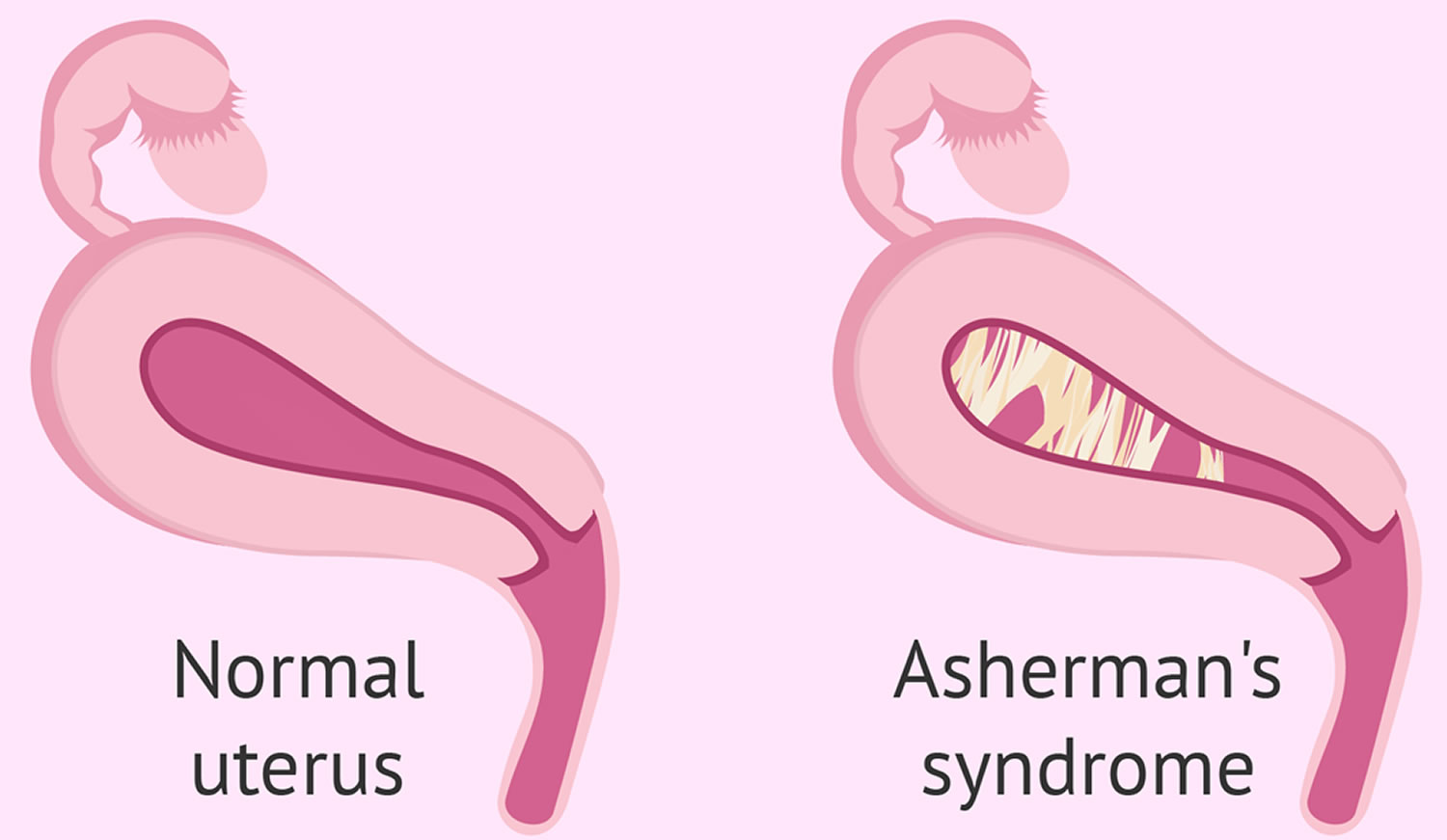 the presentation of asherman's syndrome typically involves