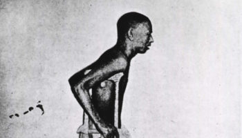 beriberi