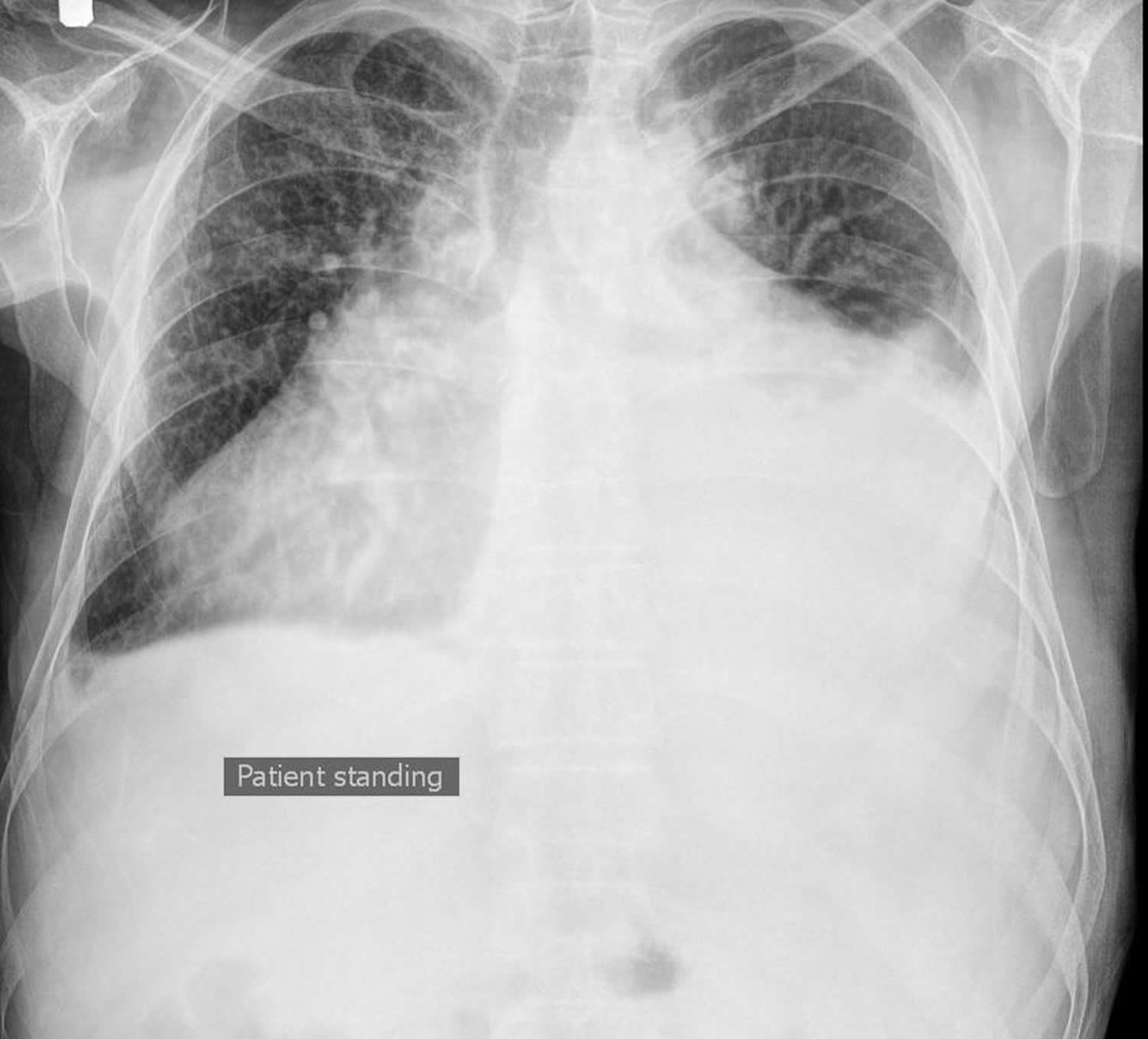 Bilateral Pleural Effusion X Ray - View Image : Fluid gathers in the ...