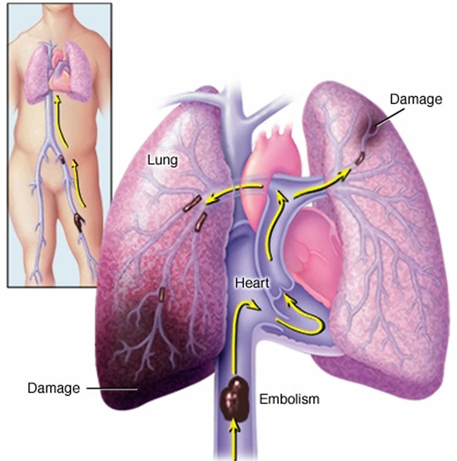 Blood Clot Causes Symptoms Diagnosis Prevention Prognosis Treatment