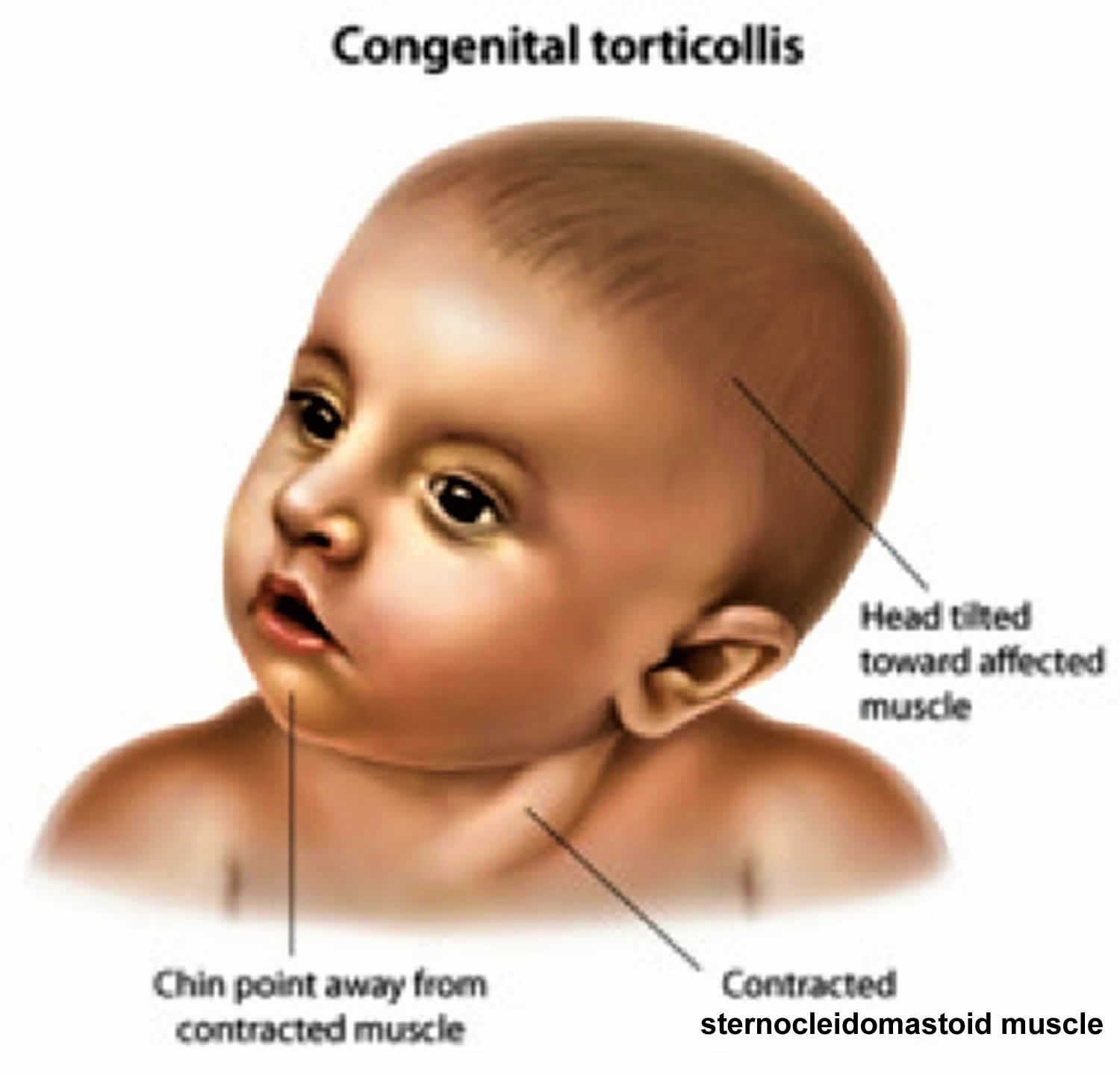 torticollis-in-adults-spasmodic-torticollis-infant-torticollis-causes