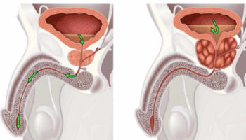 enlarged prostate