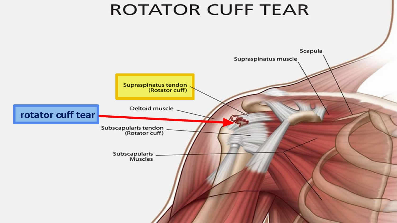 Rotator Cuff Full Thickness Tear Of The Left Shoulder Rotator Cuff My 