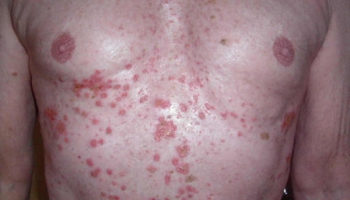 grovers disease
