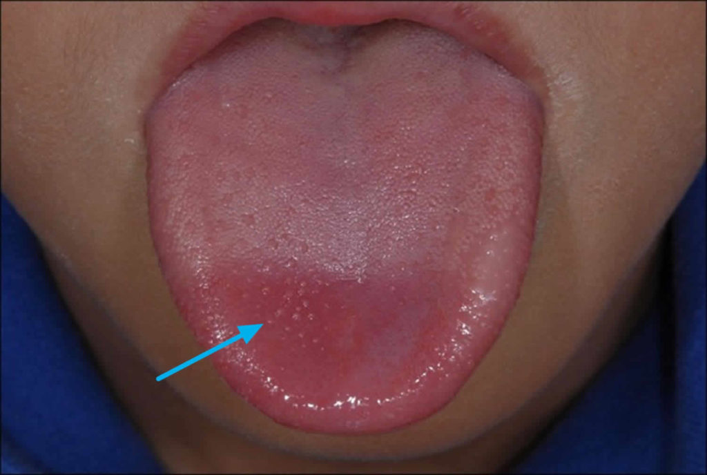 Lump Under Tongue Doctor Or Dentist At Cynthia Farley Blog