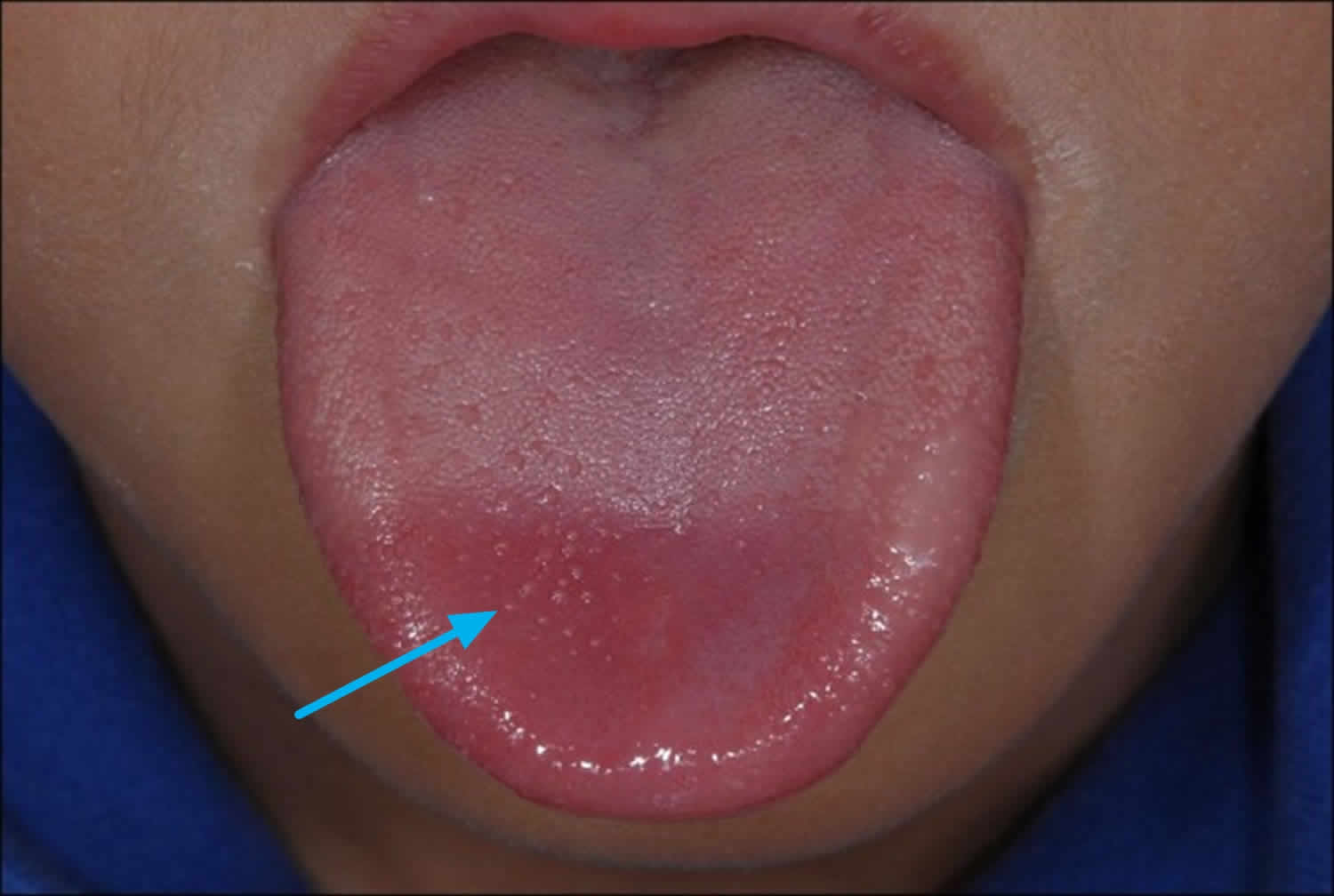 Lie Bumps On Top The Tongue 