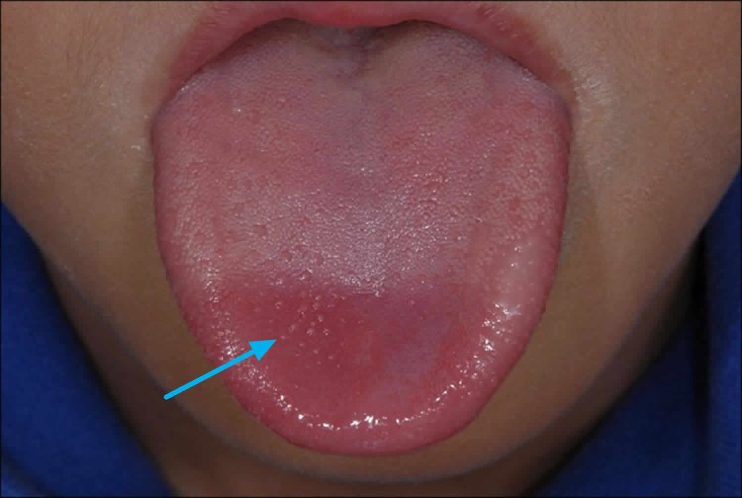 sore-white-bumps-on-tongue