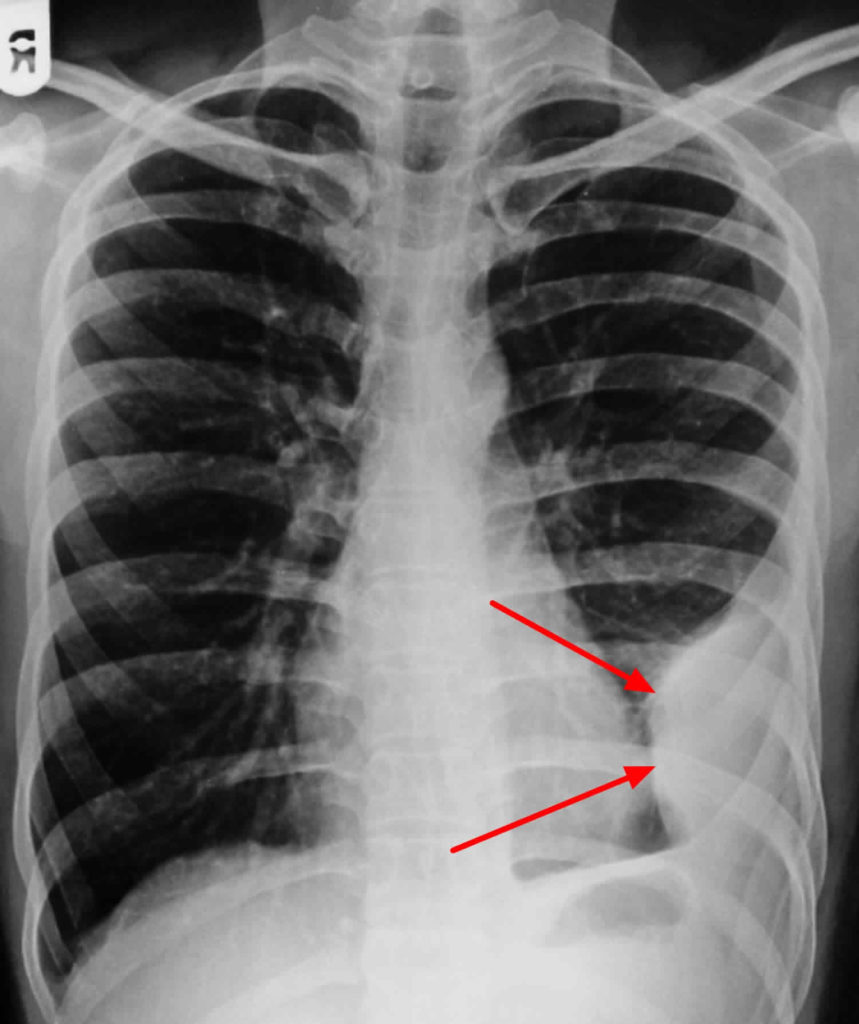 Pleural Effusion Causes, Types, Symptoms, Diagnosis And Treatment