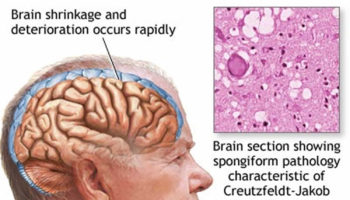 mad cow disease in humans