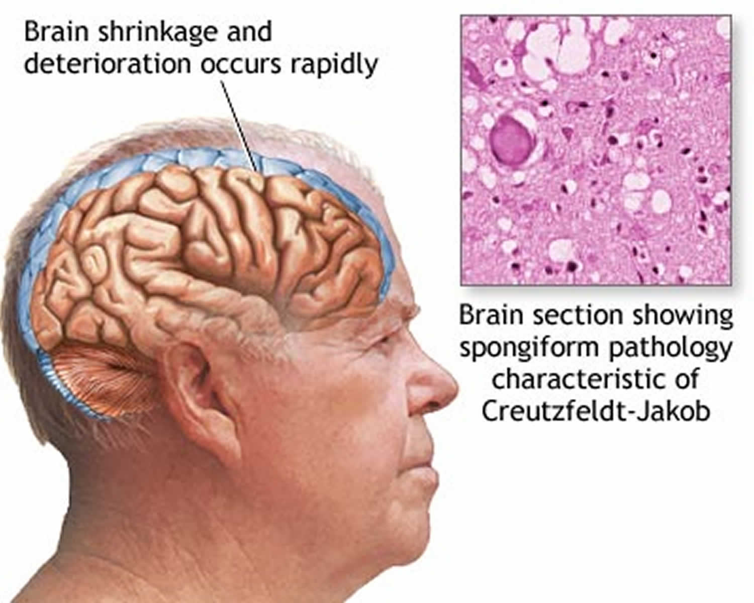 Mad cow disease in humans causes, symptoms, diagnosis and treatment