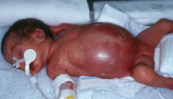 necrotizing enterocolitis