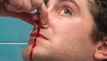 nose bleeds