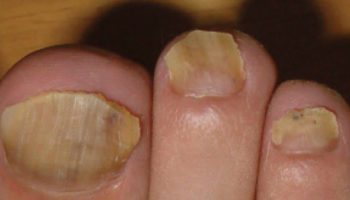 onychomycosis