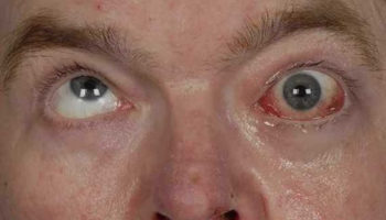ophthalmoplegia