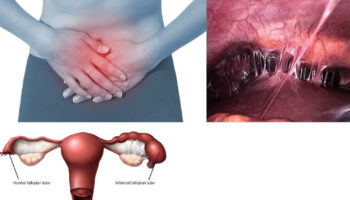 pelvic inflammatory disease