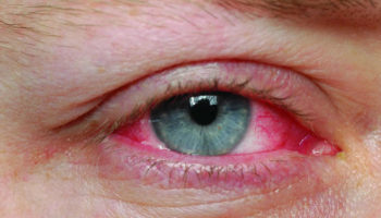 pink eye