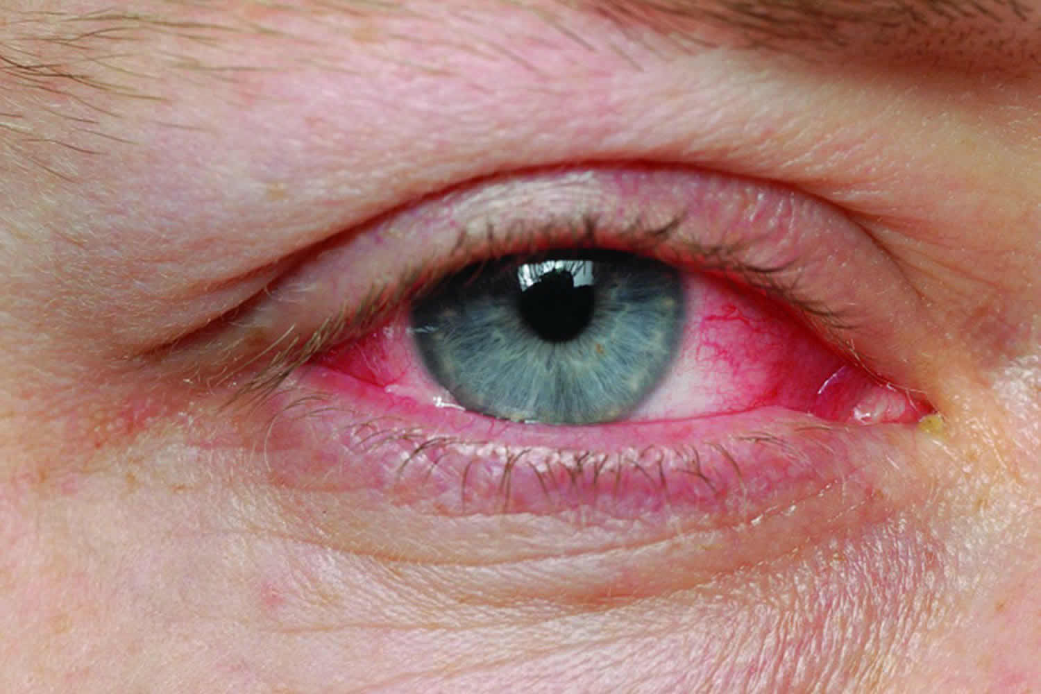 Pink Eye Epidemic 2024 - Prudi Carlotta