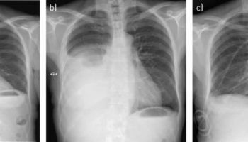 pleural effusion