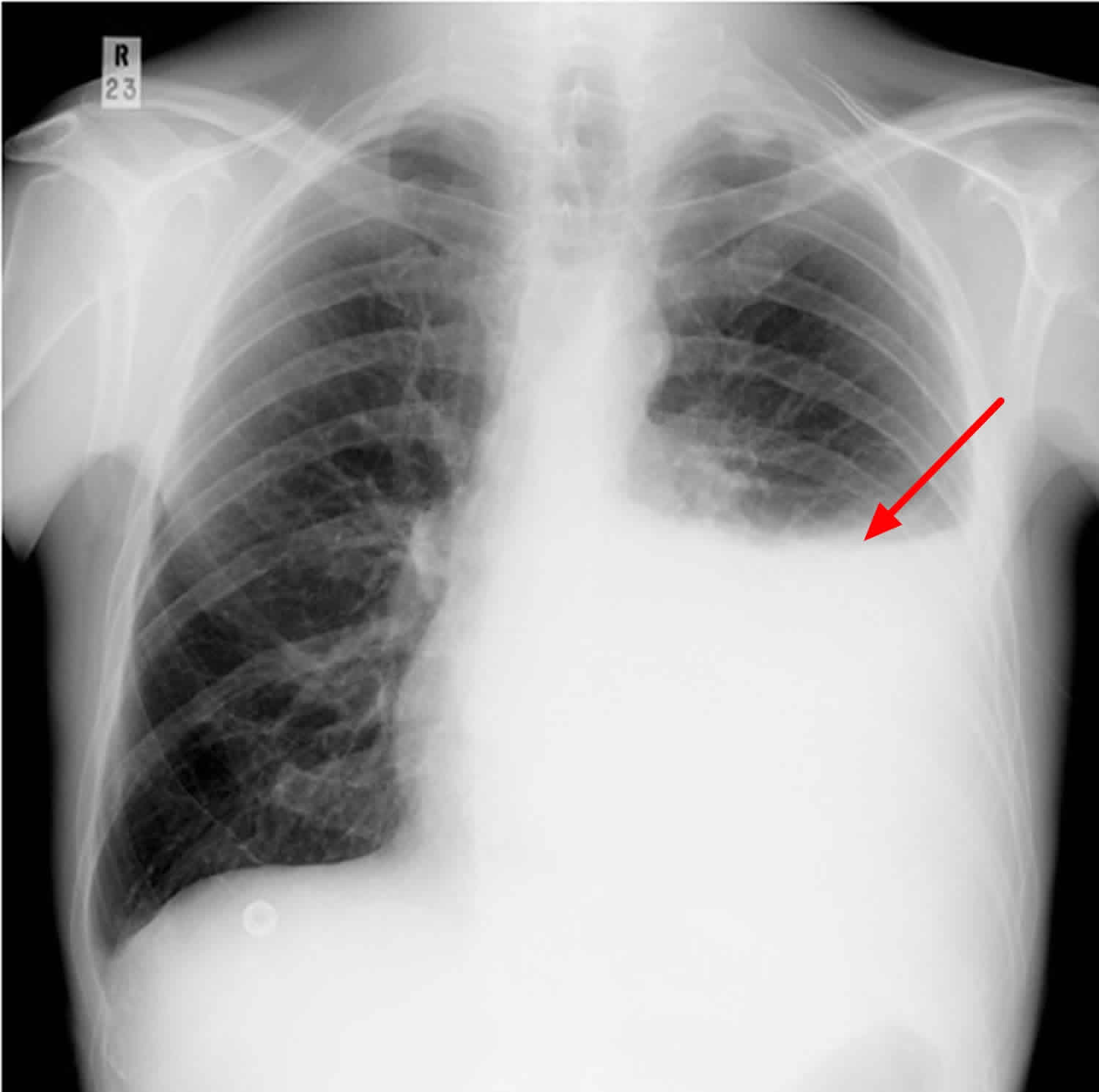 Posteroanterior Chest Radiograph Showing Right Pleural Effusion And A Sexiz Pix 4279