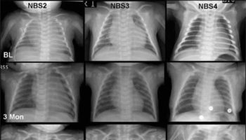 pompe disease