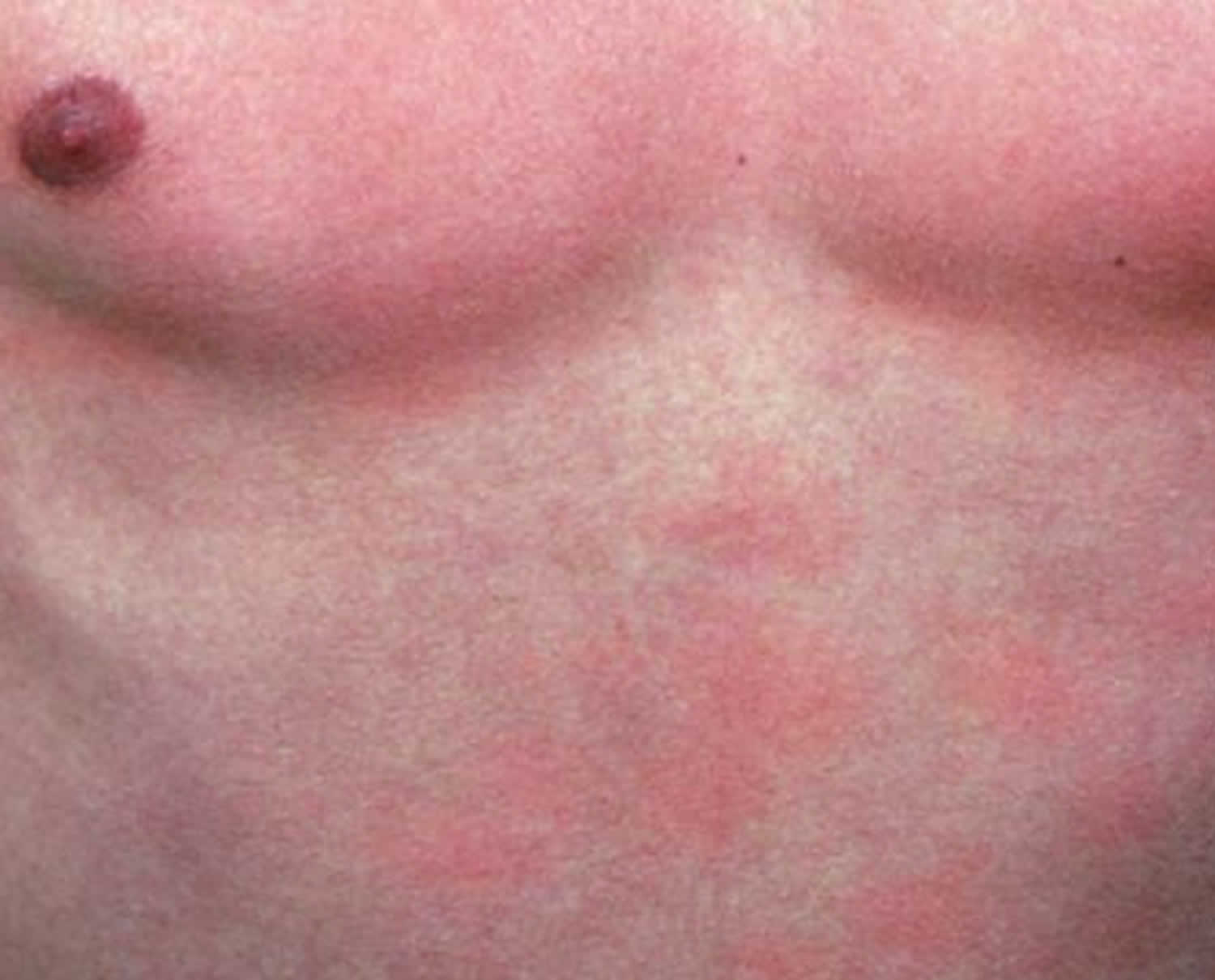 What Does A Heat Rash Look Like On A Child