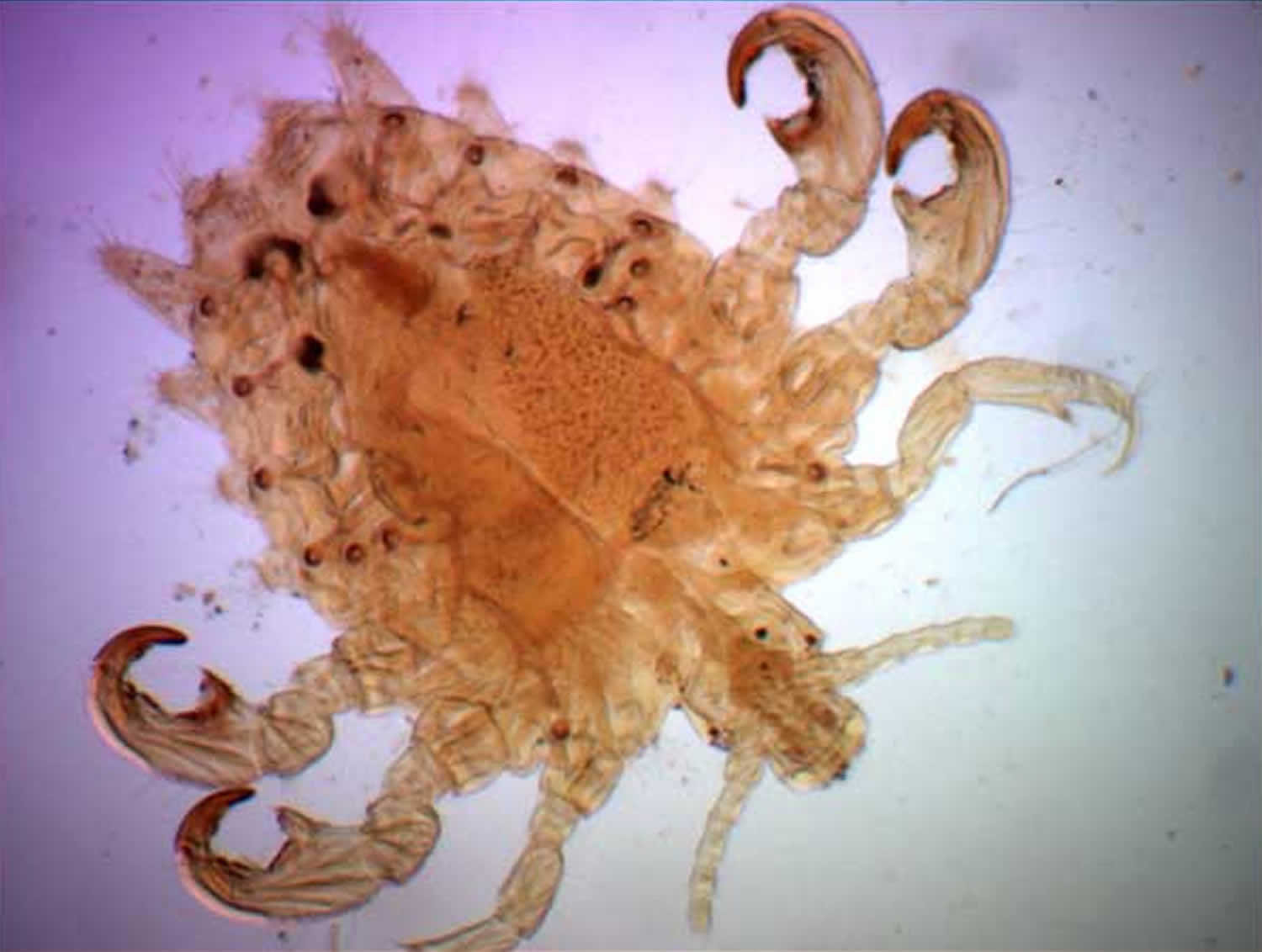 Pubic Lice Or Crab Lice Signs Symptoms Transmission Pubic Lice