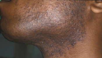 razor bumps