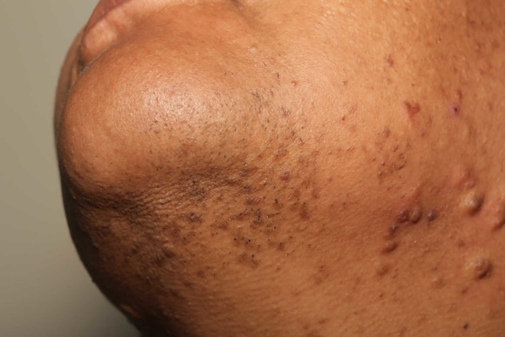 Razor bumps causes, prevention & learn how to get rid of razor bumps