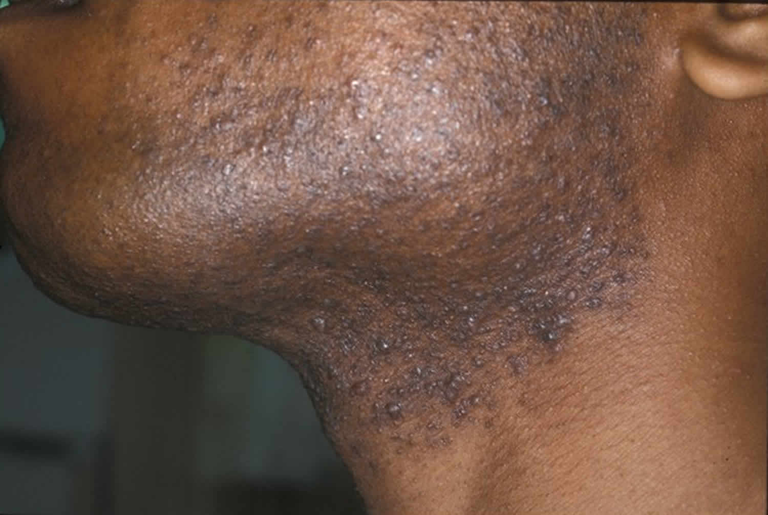 How To Get Rid Of Razor Bumps On The Back Of Your Neck