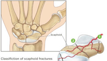 scaphoid fracture