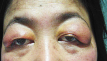 sjogren’s syndrome