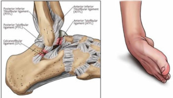 sprained ankle