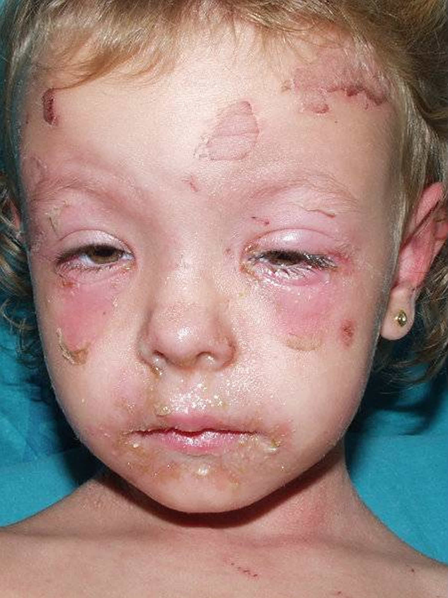 Scalded Skin Syndrome Staphylococcal Scalded Skin Syndrome Treatment