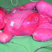 staphylococcal scalded skin syndrome