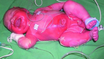 staphylococcal scalded skin syndrome