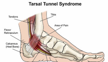 tarsal tunnel syndrome