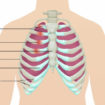 tietze syndrome