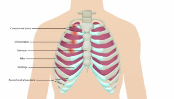 tietze syndrome