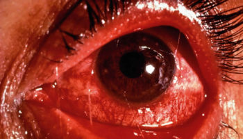 trachoma
