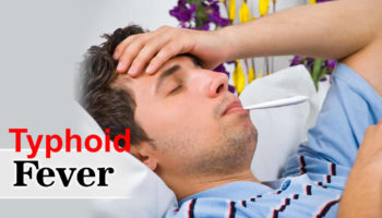 typhoid fever