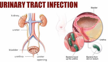 urinary tract infection