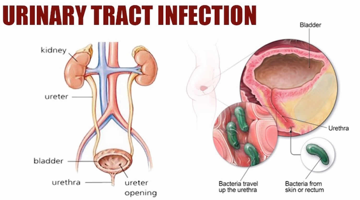 Can Candidiasis Cause Urinary Tract Infection