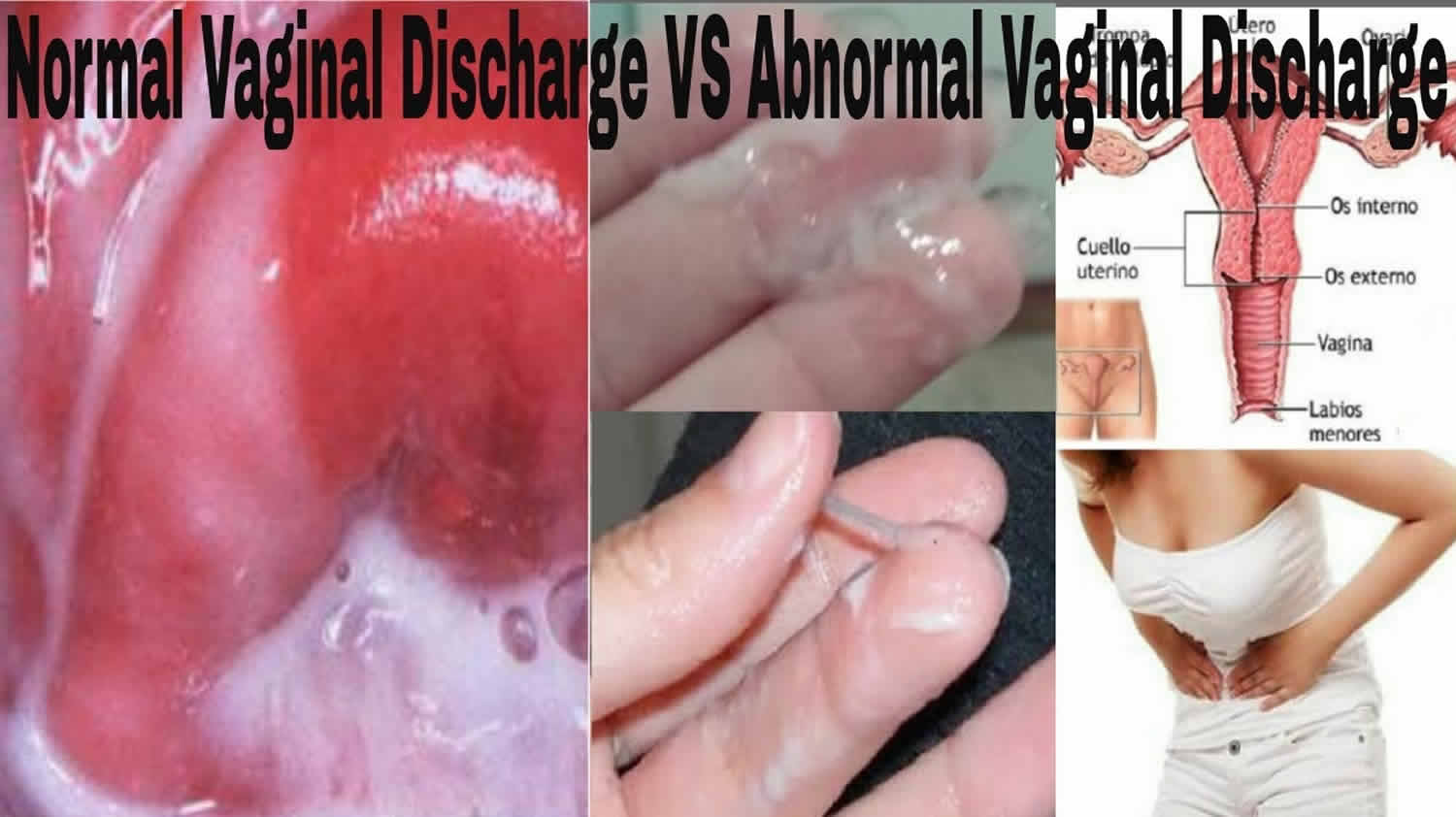 Vaginal discharge, what is normal and abnormal vaginal discharge